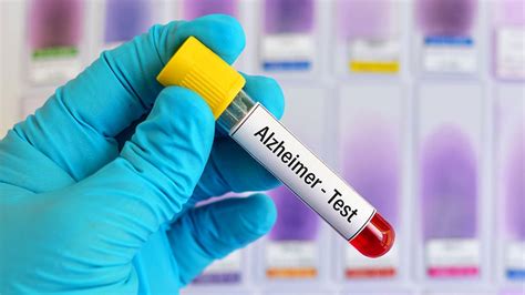Doubts abound about a new Alzheimer’s blood test